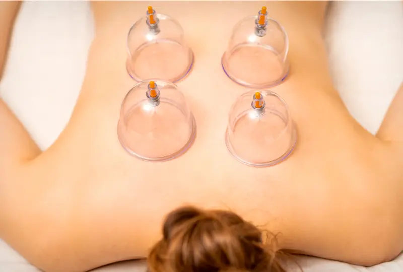Cupping body therapy